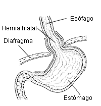 Hernia Hiatal: Causas, Síntomas y Tratamiento.