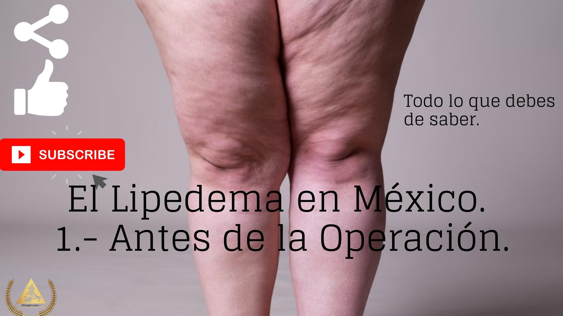 El Lipedema en México 1.- Antes de la Operación