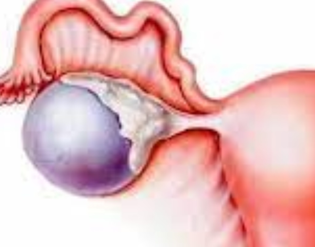 Quiste Ovárico: Conoce los Síntomas y Tratamientos.