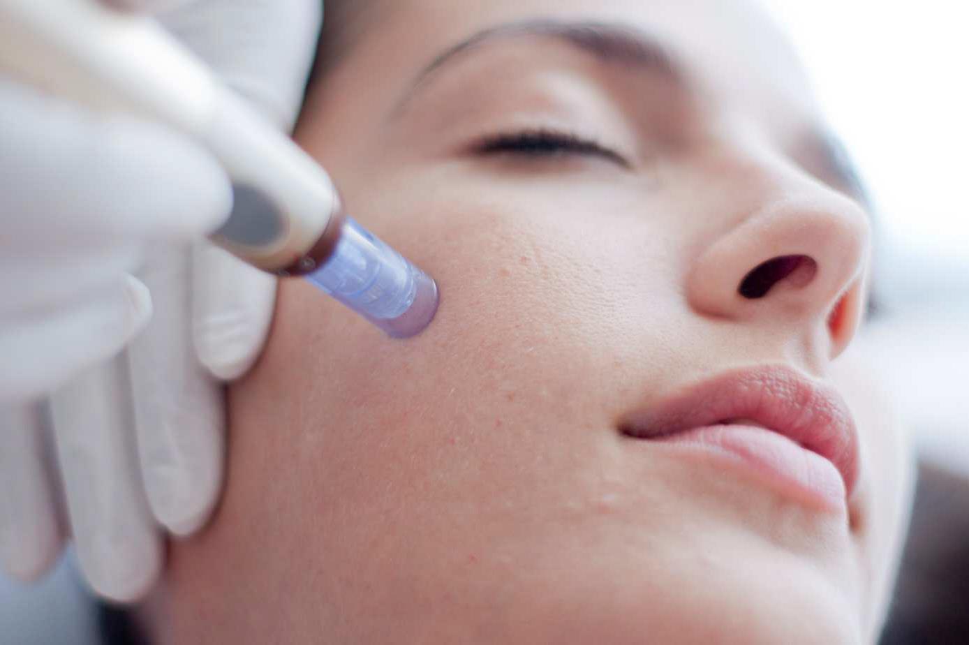 Microneedling