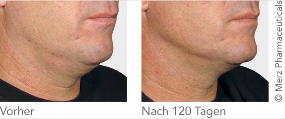 Wirkung Ultherapy München