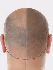 PRP Patelet Rich Plasma Behandlung,  Eigenblut, Haarverlust, Haarausfall - Google