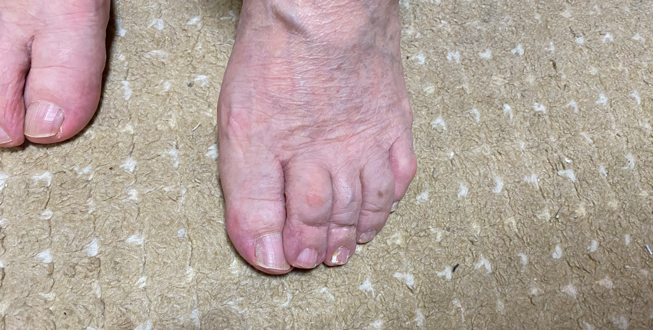 利用者さんの足の観察をしました
