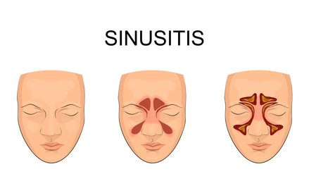 Sinusitis Eine Herausforderung Fur Hno Arzte Und Die Naturheilkunde Homoopathie Andere Ganzheitliche Gesundheitsthemen Blog