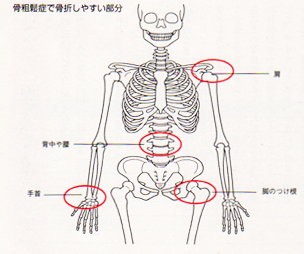 骨粗鬆症で骨折しやすい箇所