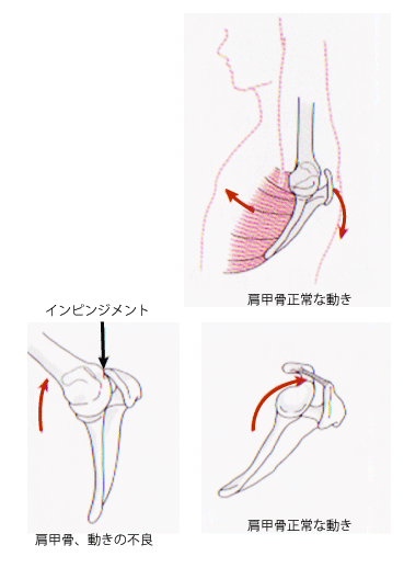肩の障害 インピンジメント症候群 ピラティス専門スタジオ シェイプアップ ダイエット 姿勢改善 腰痛肩痛改善に効果があります 肩の障害 インピンジメント症候群 ピラティス専門スタジオ シェイプアップ ダイエット 姿勢改善 腰痛肩痛改善に効果があります