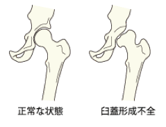 臼蓋形成不全