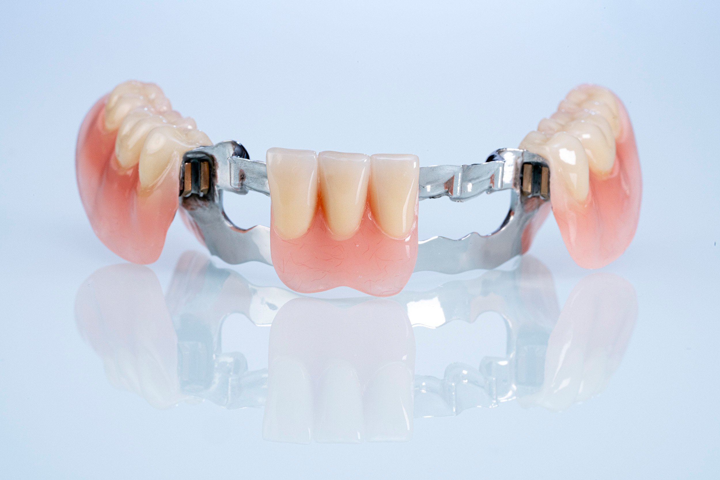 Geschiebe-Prothese – Die herausnehmbare Zahnprothese - ZAHNTECHNIK ...