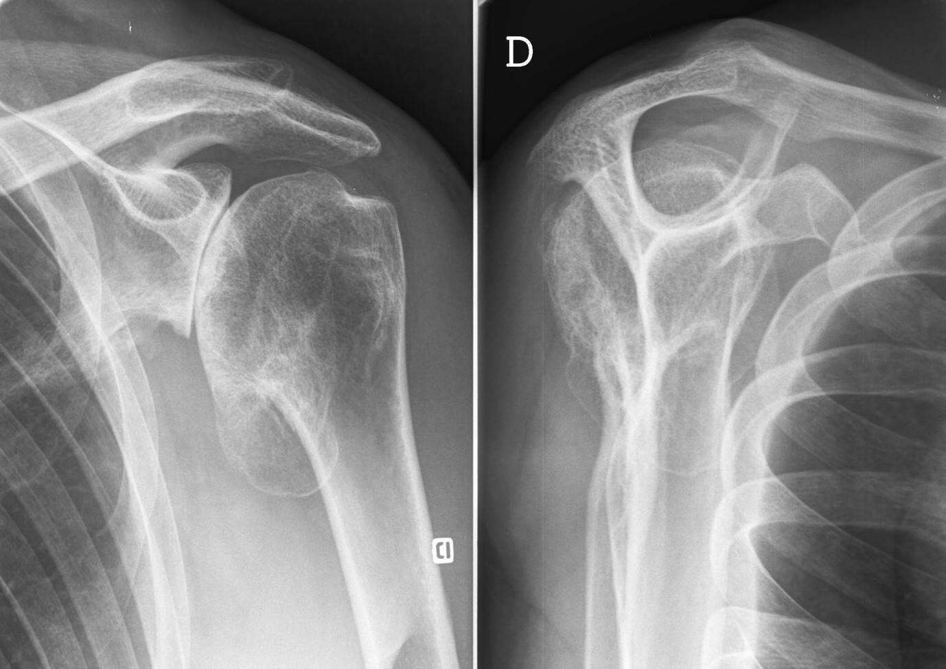 Prothese D Epaule Service D Orthopedie Du Chu De Reims