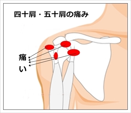 五十肩