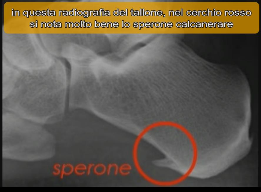 Spina Calcaneare Onde D Urto La cura della spina calcaneare - Terapia ad onde d'urto