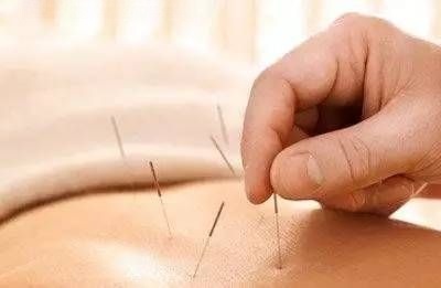 鍼をする時何本刺すかどうやって決める？