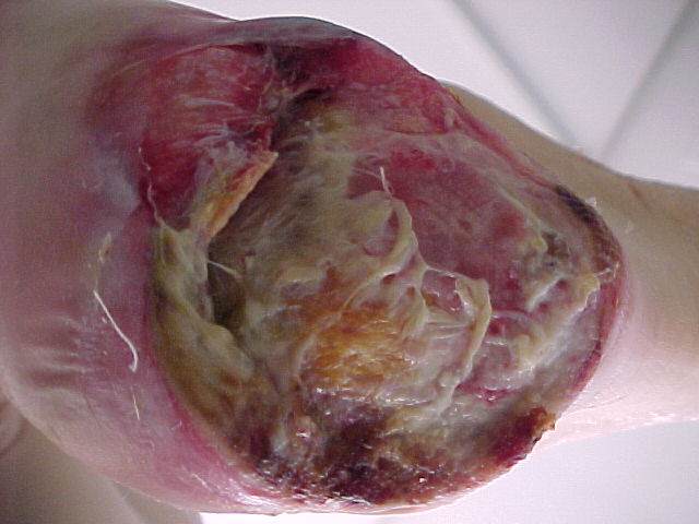 CATEGORIA IV  Pérdida total del espesor de los tejidos.  Pérdida total del espesor del tejido con hueso, tendón o músculo expuestos. Pueden aparecer esfácelos o escaras. Incluye a menudo cavitaciones y tunelizaciones. Otras características: La profundidad de la úlcera por presión de categoría/estadio IV varía según su localización en la anatomía del paciente. El puente de la nariz, la oreja, el occipital y el maléolo no tienen tejido subcutáneo (adiposo) y estas úlceras pueden ser poco profundas. Las úlceras de categoría/estadio IV pueden extenderse al músculo y/o a las estructuras de soporte (por ejemplo, la fascia, tendón o cápsula de la articulación) pudiendo provocar la aparición de una osteomielitis u osteítis. El hueso/músculo expuesto es visible o directamente palpable.  