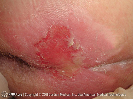 CATEGORIA II  Úlcera de espesor parcial  La pérdida de espesor parcial de la dermis se presenta como una úlcera abierta poco profunda con un lecho de la herida entre rosado y rojizo, sin esfácelos. También puede presentarse como una ampolla intacta o abierta/rota llena de suero o de suero sanguinolento. Otras características: Se presenta como una úlcera superficial brillante o seca sin esfácelos o hematomas*. Esta categoría / estadio no debería emplearse para describir desgarros de la piel, quemaduras provocadas por el esparadrapo, dermatitis asociada a la incontinencia, la maceración o la excoriación. *El hematoma sugiere lesión de tejidos profundos.  