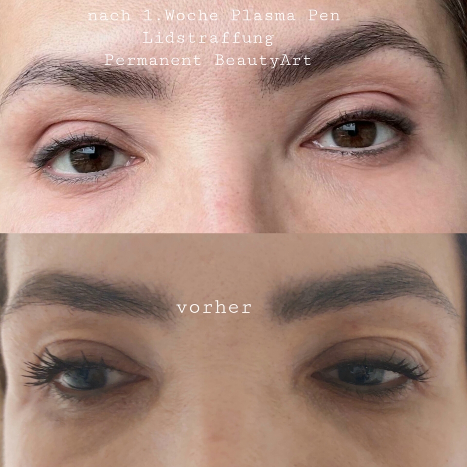 Plasma Pen Lidstraffung bei Permanent BeautyArt in Kriens 