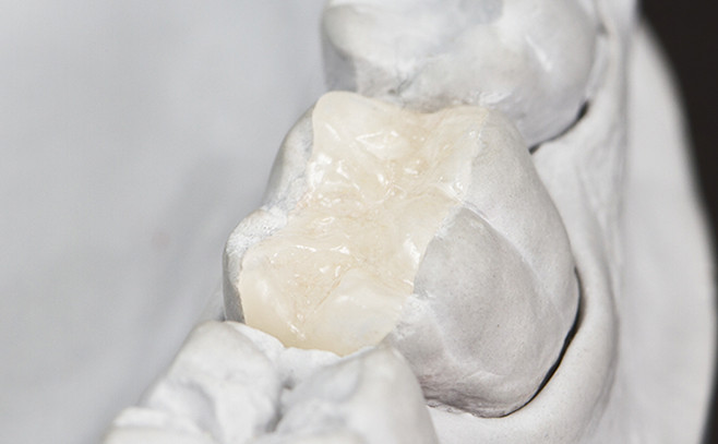 Keramik-Füllungen (Inlays) - Zahnarztpraxis Eberl