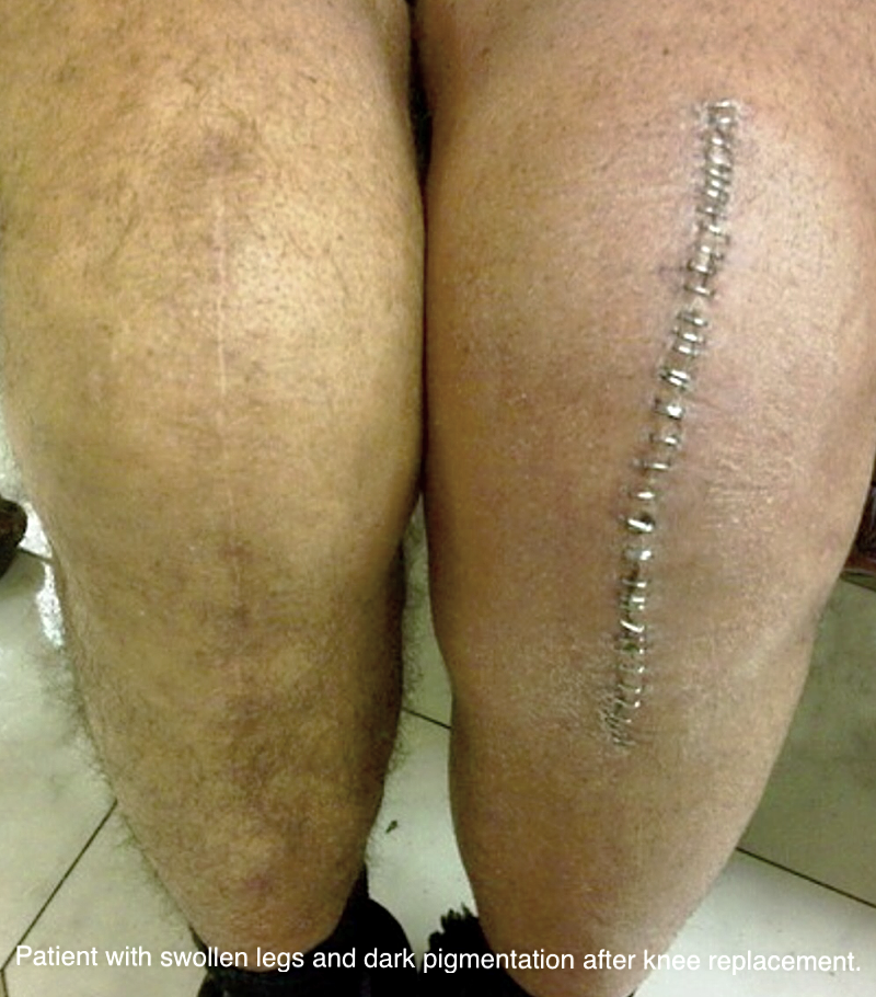 Leg swelling after knee surgery is often caused by an underlying vein condition.