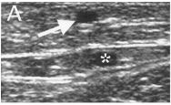 Superficial great saphenous vein, variable anatomy of the venous system