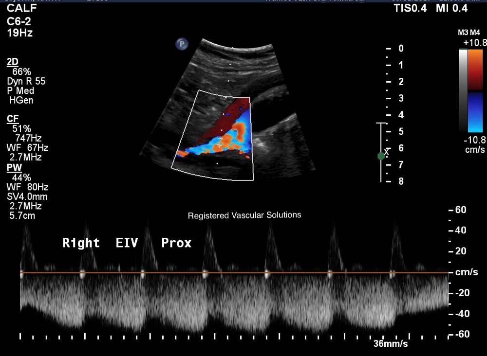 High grade right external iliac vein compression on a patient that was told they had a negative for venous problems and had suffered a pulmonary embolism. 