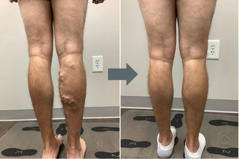 Truffles Vein Specialists patient with significant venous insufficiency and large varicose veins, before and after vein treatment in Georgia.