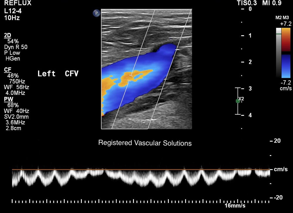 Continuous pulsatile flow in the left common femoral vein suggestive of proximal compression or thrombosis. 