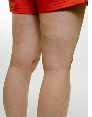 Mild varicose vein in the back of the leg. Varicose veins are not a cosmetic but medical problem. Vein treatment options in Atlanta, Georgia.