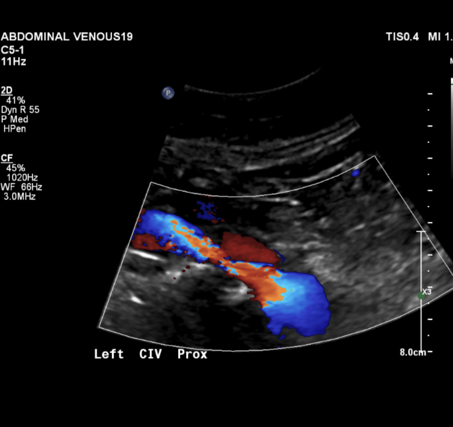 Left proximal common iliac vein compression. The flow increases in speed through the compressed area. Normal flow is dark blue, the fastest flow is orange-red and turbulent. 