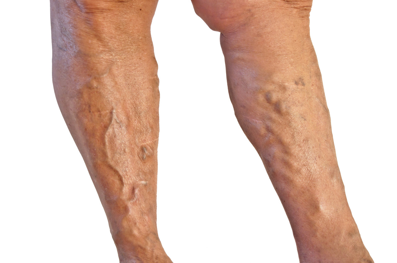 Radiofrequency Ablation Varicose Veins Truffles Vein Specialists