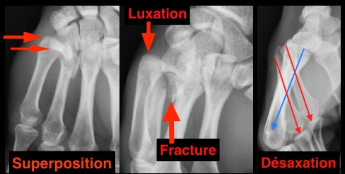 fractura mano cirugia deportiva Dr Rémi Toulouse ortopedia La Croix du Sud