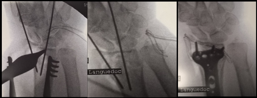 Fractura de la muneca cirugia deportiva Toulouse ortopedia Dr Rémi