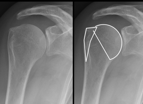 Fractura del hombro, Dr Rémi cirugia deportiva traumatologia Toulouse