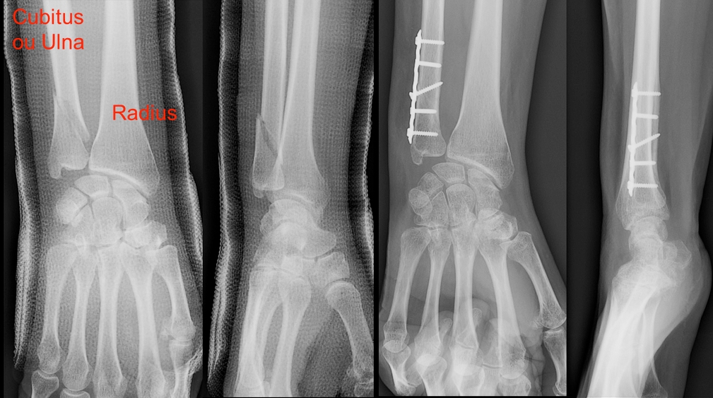FRACTURE Dr Rémi chirurgien orthopédiste à Toulouse