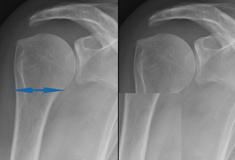 cirugia deportiva traumatologia, dr Rémi Toulouse ortopedista Croix du Sud