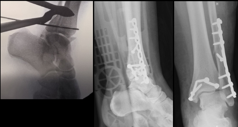 fracture cheville trimalléolaire chirurgie sport traumatologie orthopédie Dr Rémi Toulouse