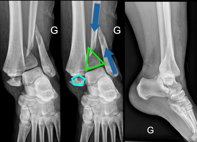 fractura trimaleolar de tobillo
