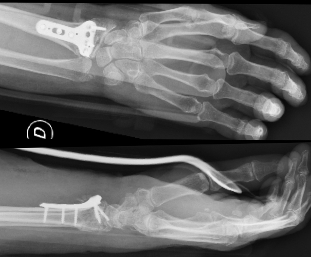 FRACTURE Dr Rémi chirurgien orthopédiste à Toulouse