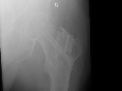 enlever clou gamma ostéosynthèse du fémur sans risque personne  agée  chirurgie orthopédique Dr Rémi Toulouse