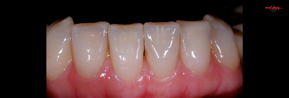  ROSI, TOTAL MIXED REHABILITATION WITH ADDITIONAL CROWNS AND VENEERS IN FELDSPAR CERAMIC