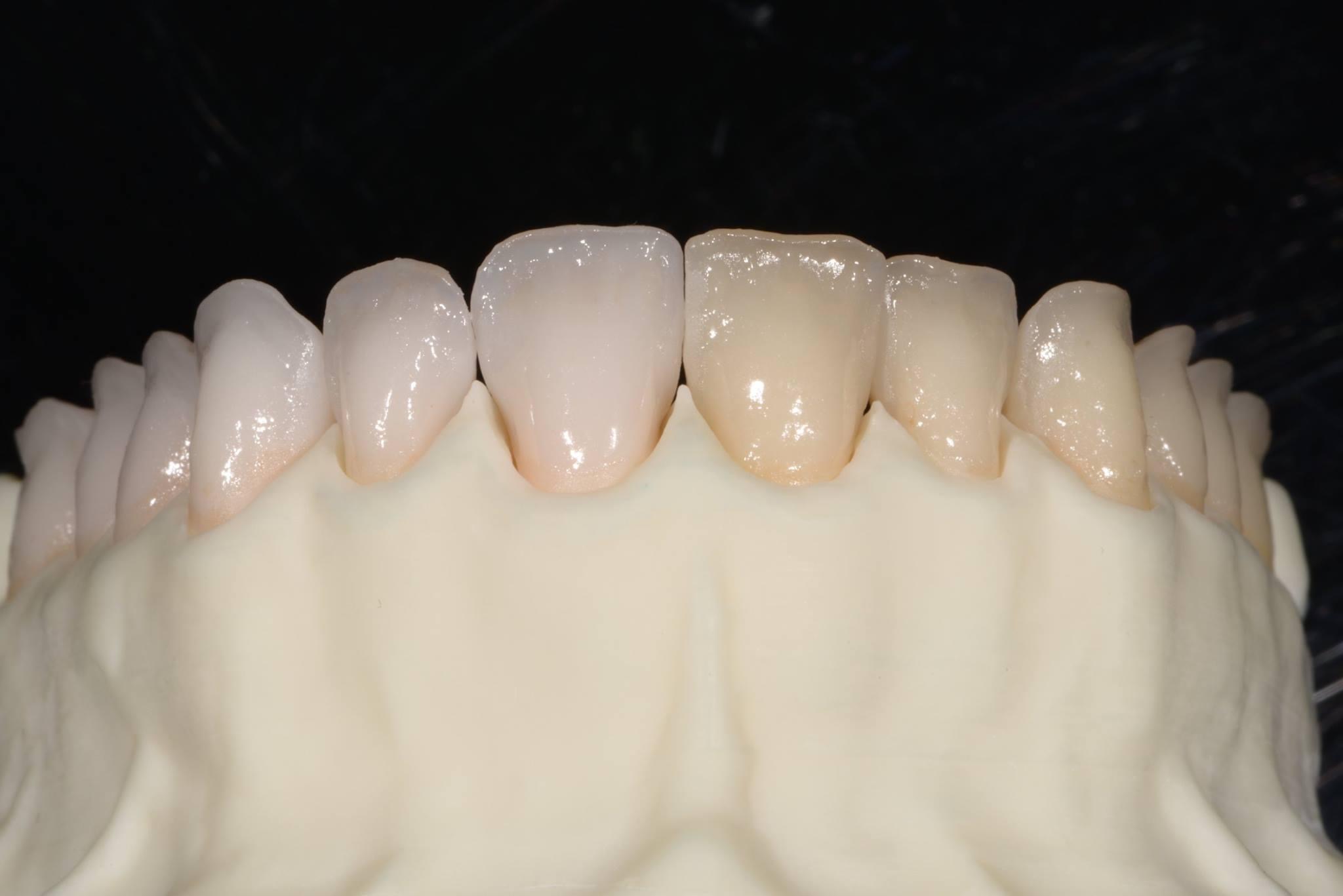 Lithium disilicate cutback technique monolithic incisal edge