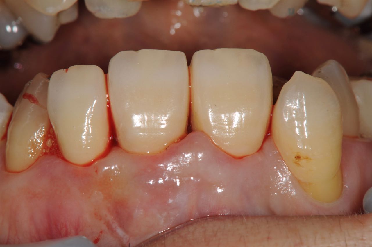 Case-3 State in the mouth immediately after the zirconia crown with three crowns connected is set