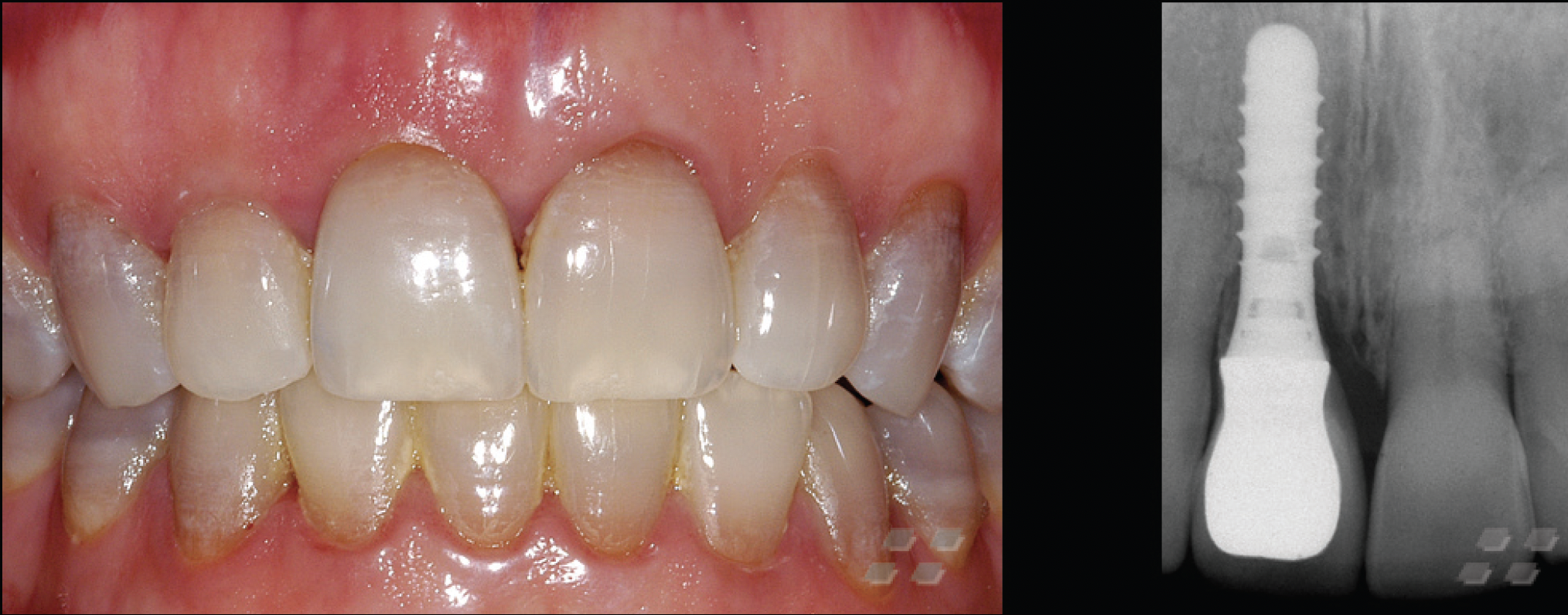 Implant Supported Ceramic Crowns