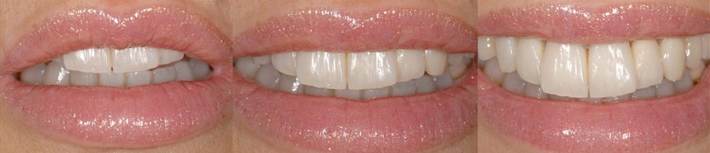  MANUELA, TOTAL MIXED REHABILITATION WITH ADDITIONAL CROWNS AND VENEERS IN FELDSPAR CERAMIC AFTER ORTHODONTICS