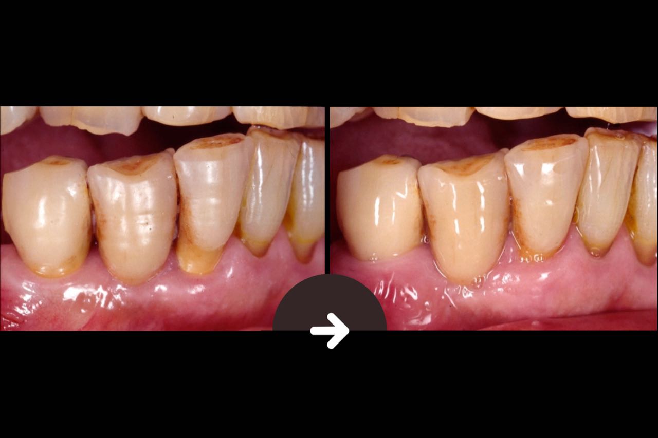 Case-8 3 metal ceramic bridge crowns. It can be seen from the photograph that the post-operative gum is restored