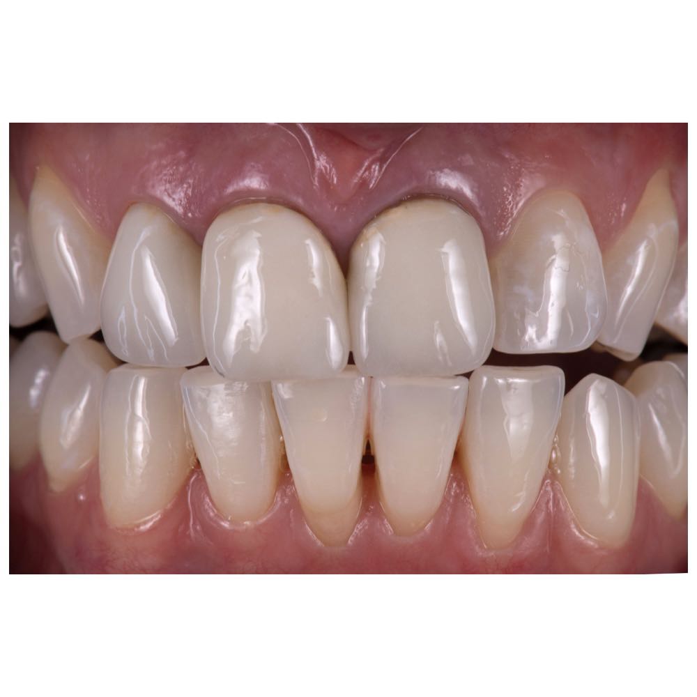 Case 2. Before. 3 Front tooth crown case. 