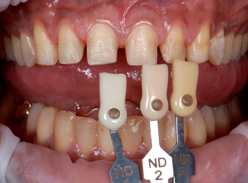 Case-5  veneers. Upper carving