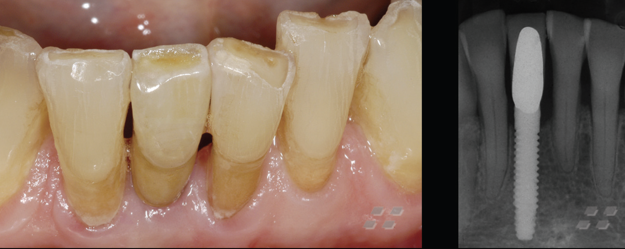 Implant Supported Ceramic Crowns