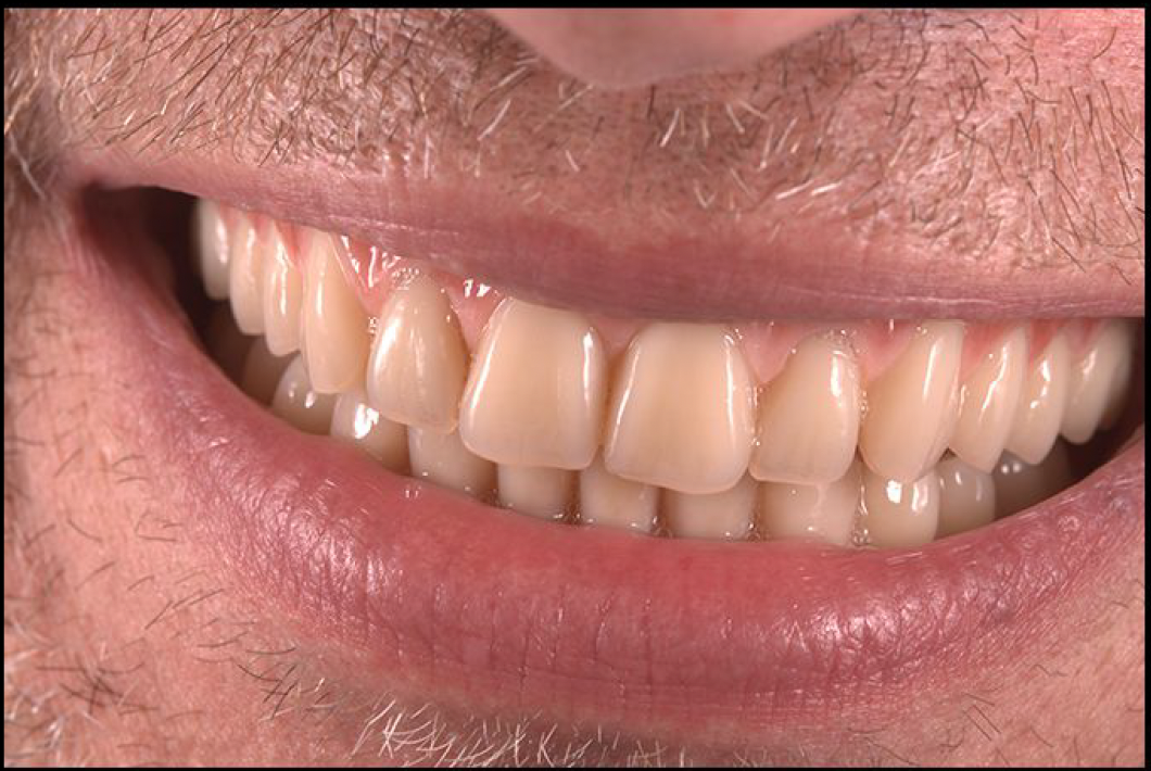 Conus: Implant Overdenture Solution