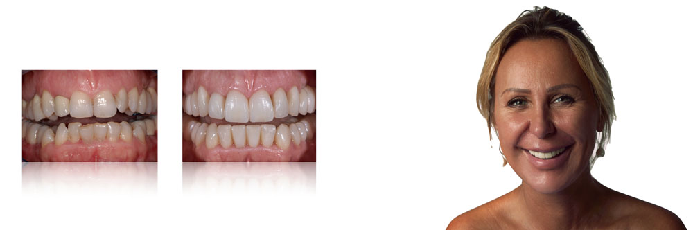  SIMONA, TOTAL MIXED REHABILITATION WITH ADDITIONAL CROWNS AND VENEERS IN FELDSPAR CERAMIC