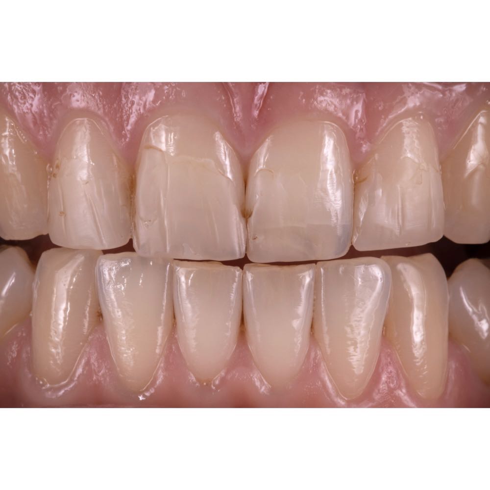 Case 1.  Before. 4 front tooth crown case. 