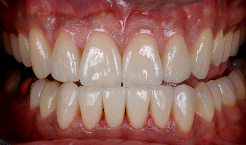 Case-5  veneers. Final